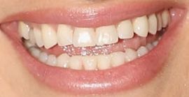 Picture of Idina Menzel teeth and smile