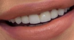 Picture of Iggy Azalea teeth and smile