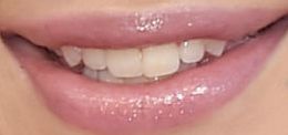 Picture of Iggy Azalea teeth and smile