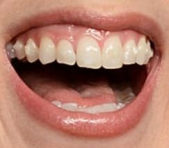 Picture of Iliza Shlesinger teeth and smile