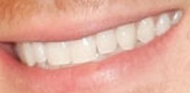 Picture of Jacob Busch teeth and smile