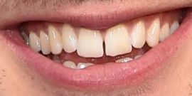 Picture of Jacob Elordi teeth and smile