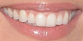 Picture of Jade Roper teeth and smile
