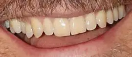 Picture of Jake Gyllenhaal teeth and smile