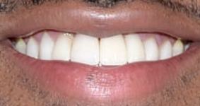 Picture of Jaleel White teeth and smile