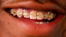Picture of Jaleel White teeth and smile
