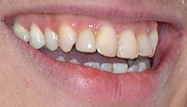Picture of Jamie Campbell Bower teeth and smile