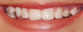 Picture of Jamie Lynn Spears teeth and smile