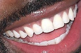 Picture of Jason Derulo teeth and smile