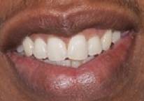 Jay-Z teeth