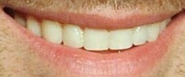 Picture of Jeff Dye teeth and smile
