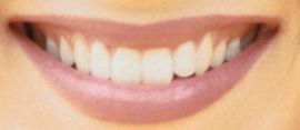 Jennifer Aniston's teeth
