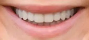 Jennifer Lawrence's teeth