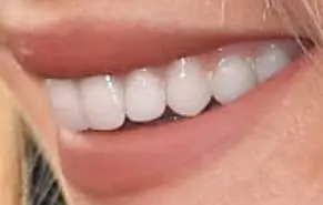 Picture of Jennifer Lawrence's teeth and smile