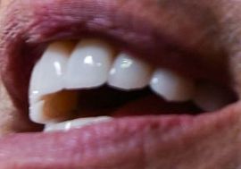 Picture of Jerry Seinfeld teeth and smile