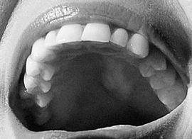 Picture of Jessie J teeth and smile