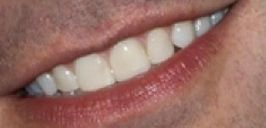Picture of Jimmy Fallon's teeth and smile