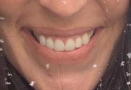 Picture of Joanna Gaines teeth and smile