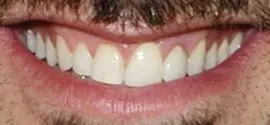 Picture of Joey Fatone teeth and smile