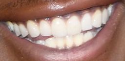 John Boyega's teeth