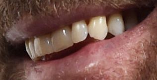 John Travolta teeth