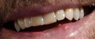 John Travolta teeth