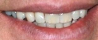 Picture of John Travolta teeth and smile