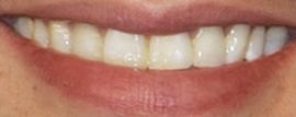 Picture of Juanes teeth and smile