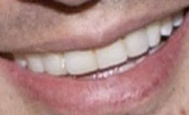 Picture of Juanes teeth and smile