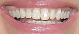 image of Julia Roberts teeth and smile