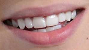 Justin Bieber's teeth