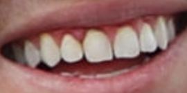 Picture of Justin Thomas teeth and smile