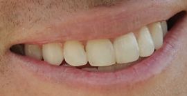 Picture of Justin Thomas teeth and smile