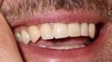 Justin Timberlake's teeth