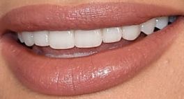 Picture of Kacey Musgraves teeth and smile