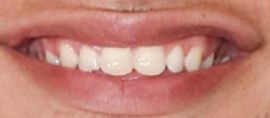 Picture of Kane Brown teeth and smile