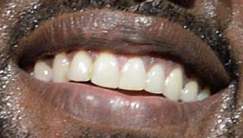 Kanye West teeth