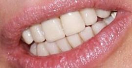 Picture of Karen Mulder teeth and smile