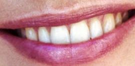 Picture of Karen Mulder teeth and smile