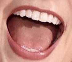 Karlie Kloss teeth