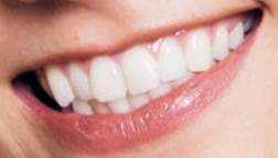 Karlie Kloss teeth