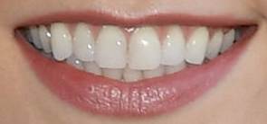 Karlie Kloss teeth and smile