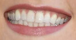 Karlie Kloss teeth and smile
