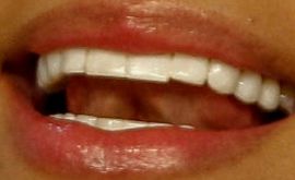Picture of Karol G teeth and smile