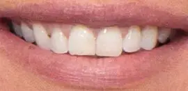 Picture of Kate Chastain teeth and smile