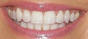 Picture of Kate Gosselin teeth and smile