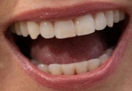 Picture of Kate Gosselin teeth and smile