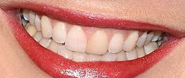 Picture of Kate Miner teeth and smile
