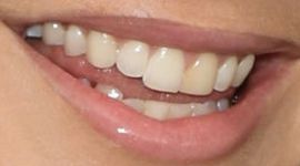 Picture of Kate Miner teeth and smile