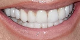 Picture of Kathie Lee Gifford teeth and smile